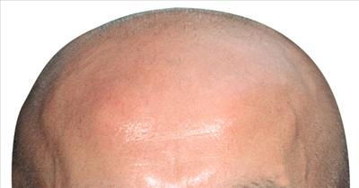 Are You Gonna Be Bald