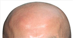 Are You Gonna Be Bald