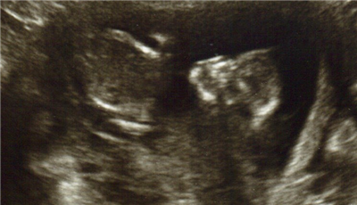 Baby Miller Gender Poll