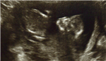 Baby Miller Gender Poll