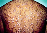 Box Of Syphilis