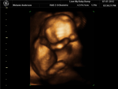 Baby Anderson Gender Poll