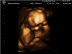 Baby Anderson Gender Poll